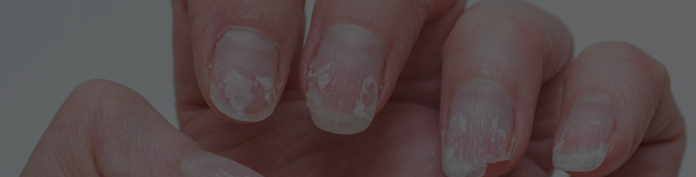 Close-up of fingernails showing visible cracks and brittleness — representing Nails and signs of nail damage for desktop view