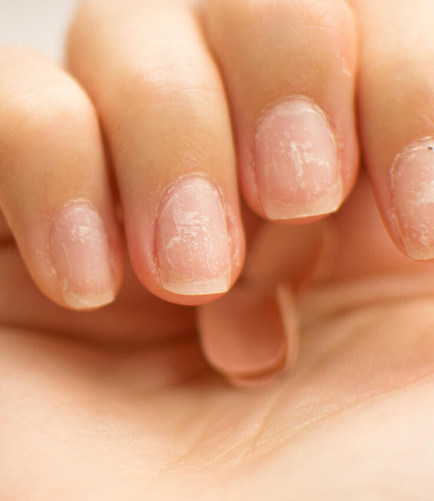 Close-up of four fingers with cracked, brittle nails — highlighting signs of nail damage and poor nail health